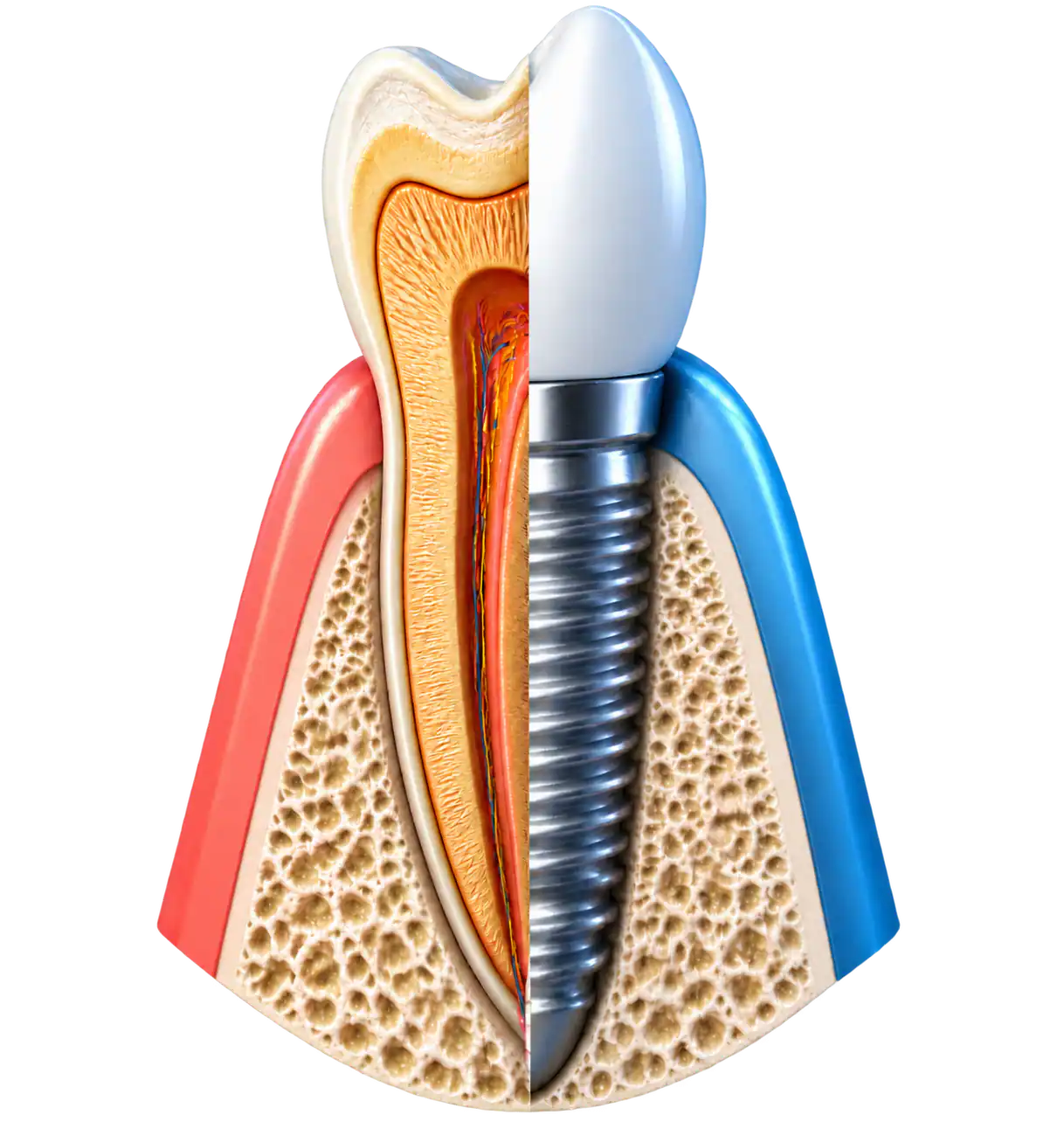 Cross-section comparing a natural tooth and a dental implant