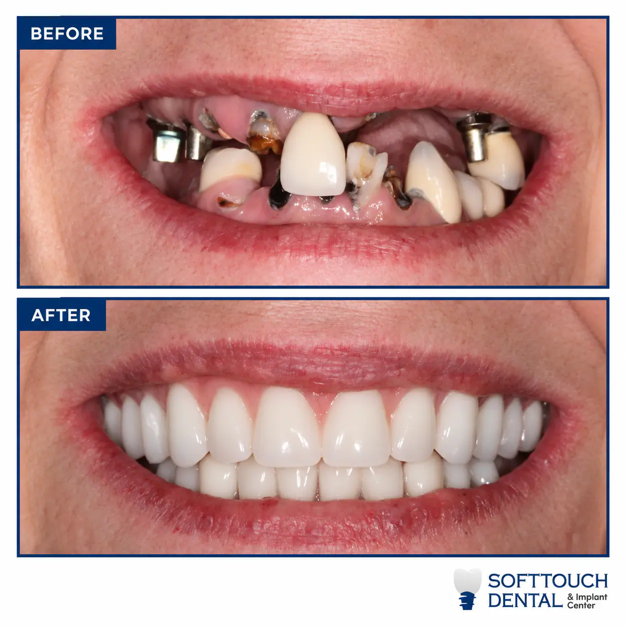 Before and after: failing teeth and old implants replaced with a full new smile
