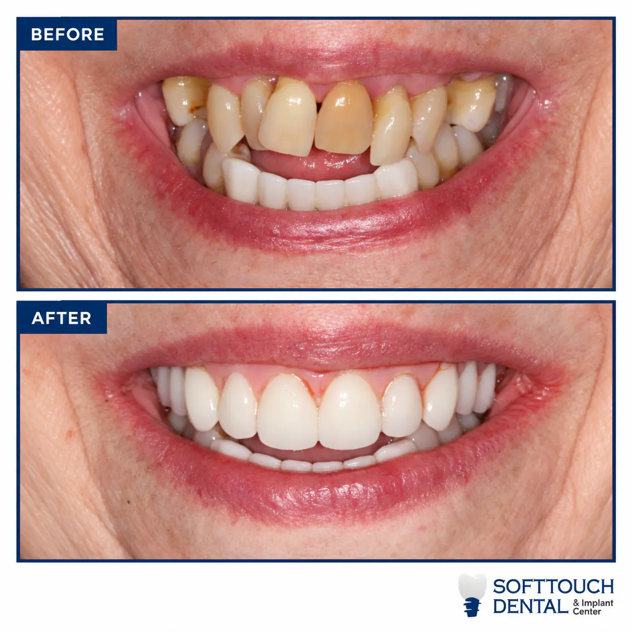 Before and after: yellowed, crowded teeth replaced with a natural white smile