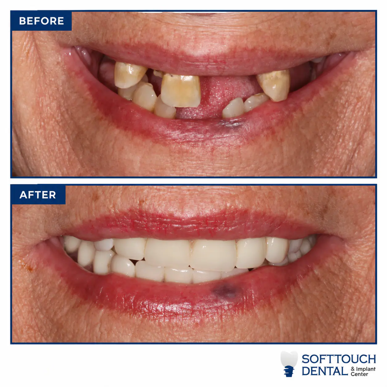 Before and after: missing front teeth restored with a full arch