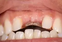fixed porcelain bridge before