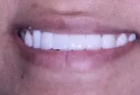 fixed porcelain bridge after