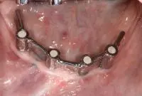 overdenture frame