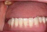 overdenture