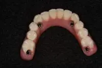 hybrid denture
