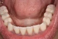 hybrid denture