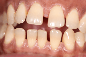 invisalign before