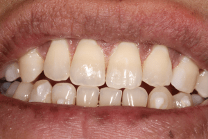 invisalign after