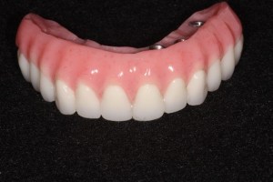 all-on-four dental implants