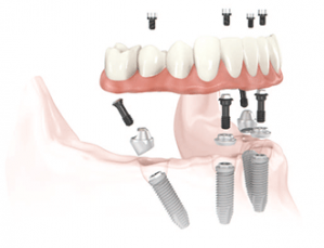 all-on-4 dental implants